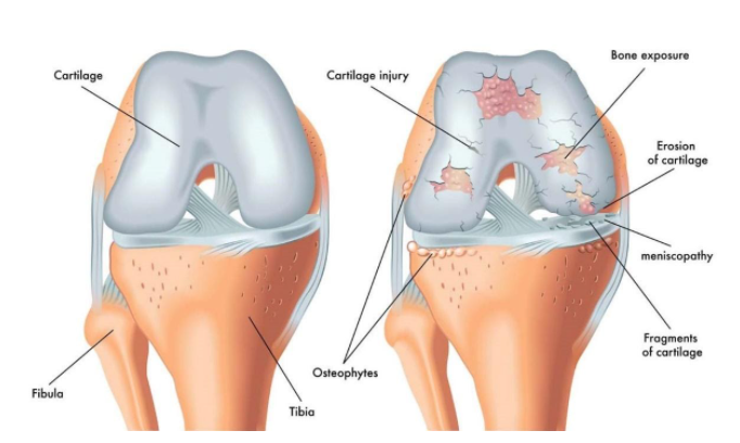 Osteoarthritis 